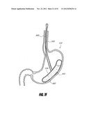 METHODS AND DEVICES FOR INTRAGASTRIC SUPPORT OF FUNCTIONAL OR PROSTHETIC     GASTROINTESTINAL DEVICES diagram and image