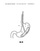 METHODS AND DEVICES FOR INTRAGASTRIC SUPPORT OF FUNCTIONAL OR PROSTHETIC     GASTROINTESTINAL DEVICES diagram and image