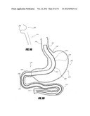 METHODS AND DEVICES FOR INTRAGASTRIC SUPPORT OF FUNCTIONAL OR PROSTHETIC     GASTROINTESTINAL DEVICES diagram and image