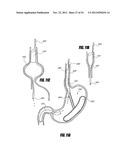 METHODS AND DEVICES FOR INTRAGASTRIC SUPPORT OF FUNCTIONAL OR PROSTHETIC     GASTROINTESTINAL DEVICES diagram and image