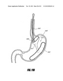 METHODS AND DEVICES FOR INTRAGASTRIC SUPPORT OF FUNCTIONAL OR PROSTHETIC     GASTROINTESTINAL DEVICES diagram and image