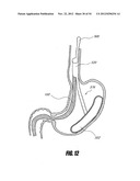 METHODS AND DEVICES FOR INTRAGASTRIC SUPPORT OF FUNCTIONAL OR PROSTHETIC     GASTROINTESTINAL DEVICES diagram and image