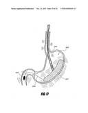 METHODS AND DEVICES FOR INTRAGASTRIC SUPPORT OF FUNCTIONAL OR PROSTHETIC     GASTROINTESTINAL DEVICES diagram and image