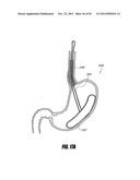 METHODS AND DEVICES FOR INTRAGASTRIC SUPPORT OF FUNCTIONAL OR PROSTHETIC     GASTROINTESTINAL DEVICES diagram and image