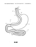 METHODS AND DEVICES FOR INTRAGASTRIC SUPPORT OF FUNCTIONAL OR PROSTHETIC     GASTROINTESTINAL DEVICES diagram and image