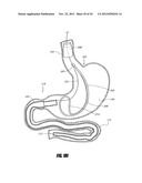 METHODS AND DEVICES FOR INTRAGASTRIC SUPPORT OF FUNCTIONAL OR PROSTHETIC     GASTROINTESTINAL DEVICES diagram and image