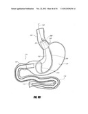 METHODS AND DEVICES FOR INTRAGASTRIC SUPPORT OF FUNCTIONAL OR PROSTHETIC     GASTROINTESTINAL DEVICES diagram and image