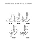 METHODS AND DEVICES FOR INTRAGASTRIC SUPPORT OF FUNCTIONAL OR PROSTHETIC     GASTROINTESTINAL DEVICES diagram and image