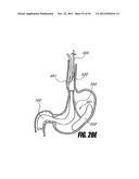 METHODS AND DEVICES FOR INTRAGASTRIC SUPPORT OF FUNCTIONAL OR PROSTHETIC     GASTROINTESTINAL DEVICES diagram and image