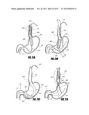 METHODS AND DEVICES FOR INTRAGASTRIC SUPPORT OF FUNCTIONAL OR PROSTHETIC     GASTROINTESTINAL DEVICES diagram and image