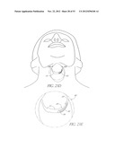 System and method for hyoidplasty diagram and image