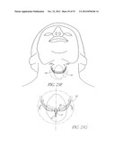 System and method for hyoidplasty diagram and image