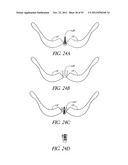 System and method for hyoidplasty diagram and image