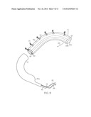 Annuloplasty Ring with Anchors Fixed by Curing Polymer diagram and image