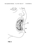 DENTAL TREATMENT AID DEVICE diagram and image