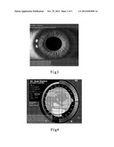 CORNEA CENTER POSITIONING METHOD FOR EXCIMER LASER KERATOMILEUSIS diagram and image