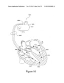 Adjusting Cardiac Pacing Response Sensing Intervals diagram and image