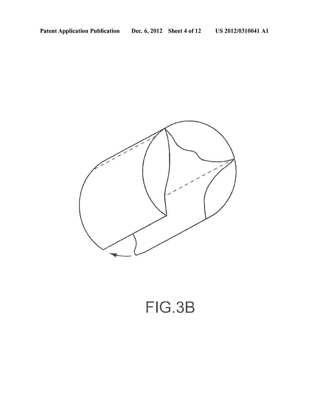 Percutaneously Implantable Replacement Heart Valve Device and Method of     Making Same - diagram, schematic, and image 05