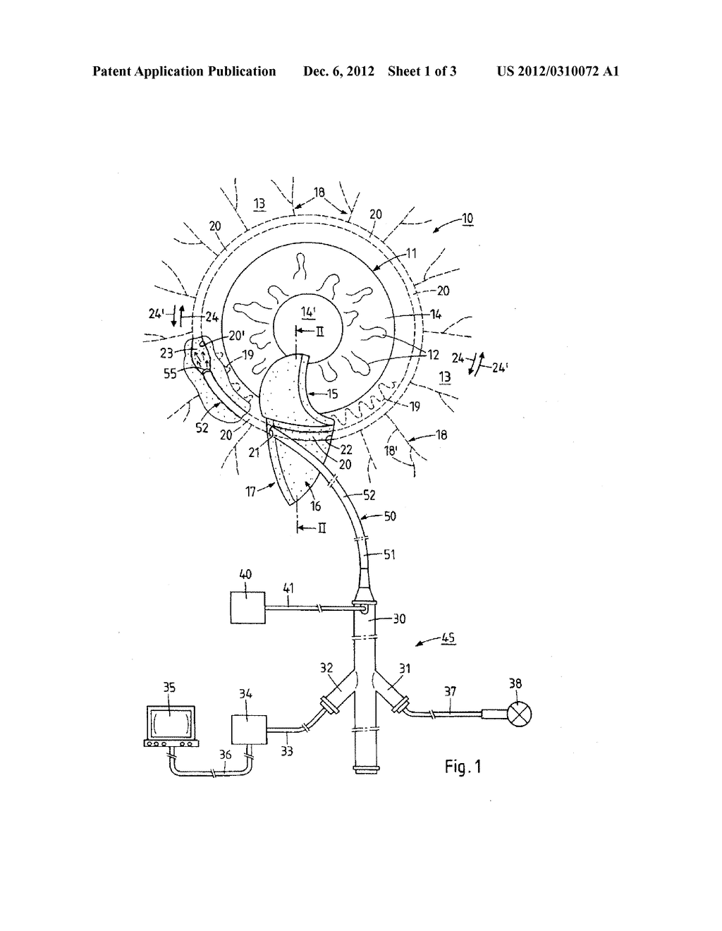 METHOD AND DEVICE FOR THE PATHOLOGY ANALYSIS OF THE SCHLEMM'S CANAL - diagram, schematic, and image 02