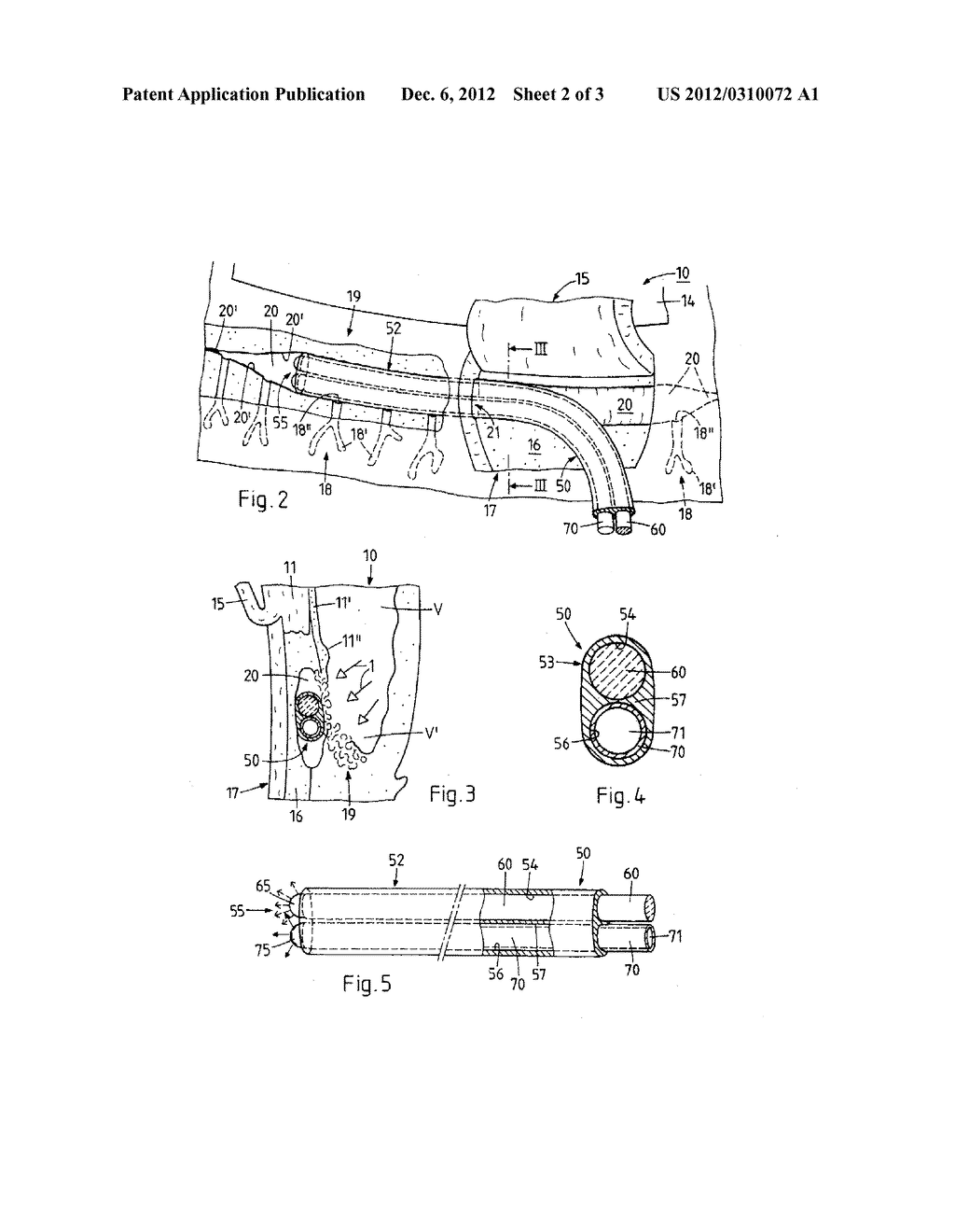 METHOD AND DEVICE FOR THE PATHOLOGY ANALYSIS OF THE SCHLEMM'S CANAL - diagram, schematic, and image 03