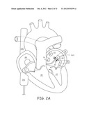 Ablation Catheters and Associated Systems and Methods diagram and image