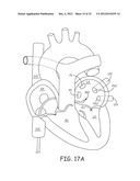 Ablation Catheters and Associated Systems and Methods diagram and image