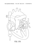 Ablation Catheters and Associated Systems and Methods diagram and image