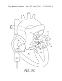 Ablation Catheters and Associated Systems and Methods diagram and image