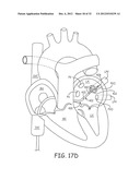 Ablation Catheters and Associated Systems and Methods diagram and image