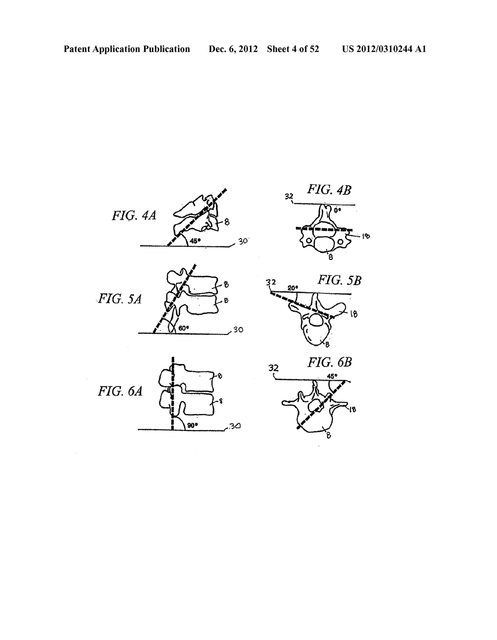 METHOD OF USING A VERTEBRAL FACET JOINT DRILL - diagram, schematic, and image 05