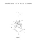 METHOD OF USING A VERTEBRAL FACET JOINT DRILL diagram and image