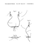 Device and Method for Nasal Surgery diagram and image