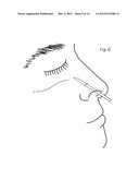 Device and Method for Nasal Surgery diagram and image