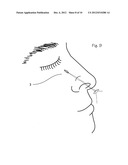 Device and Method for Nasal Surgery diagram and image