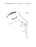 Device and Method for Nasal Surgery diagram and image