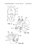 PRE-OPERATIVE PLANNING AND MANUFACTURING METHOD FOR ORTHOPEDIC PROCEDURE diagram and image