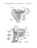 IMPLANTABLE DEVICES, SYSTEMS, AND METHODS FOR MAINTAINING DESIRED     ORIENTATIONS IN TARGETED TISSUE REGIONS diagram and image