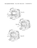 IMPLANTABLE DEVICES, SYSTEMS, AND METHODS FOR MAINTAINING DESIRED     ORIENTATIONS IN TARGETED TISSUE REGIONS diagram and image