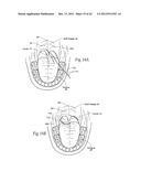 IMPLANTABLE DEVICES, SYSTEMS, AND METHODS FOR MAINTAINING DESIRED     ORIENTATIONS IN TARGETED TISSUE REGIONS diagram and image