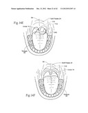 IMPLANTABLE DEVICES, SYSTEMS, AND METHODS FOR MAINTAINING DESIRED     ORIENTATIONS IN TARGETED TISSUE REGIONS diagram and image