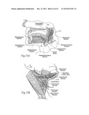 IMPLANTABLE DEVICES, SYSTEMS, AND METHODS FOR MAINTAINING DESIRED     ORIENTATIONS IN TARGETED TISSUE REGIONS diagram and image