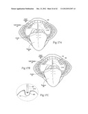 IMPLANTABLE DEVICES, SYSTEMS, AND METHODS FOR MAINTAINING DESIRED     ORIENTATIONS IN TARGETED TISSUE REGIONS diagram and image