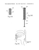 IMPLANTABLE DEVICES, SYSTEMS, AND METHODS FOR MAINTAINING DESIRED     ORIENTATIONS IN TARGETED TISSUE REGIONS diagram and image