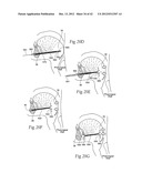 IMPLANTABLE DEVICES, SYSTEMS, AND METHODS FOR MAINTAINING DESIRED     ORIENTATIONS IN TARGETED TISSUE REGIONS diagram and image