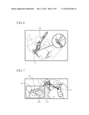 METHOD FOR TREATMENT OF PELVIC ORGAN PROLAPSE CONDITIONS diagram and image