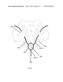 BODILY IMPLANTS AND METHODS OF TREATING FECAL INCONTINENCE USING BODILY     IMPLANTS diagram and image