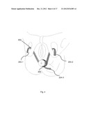 BODILY IMPLANTS AND METHODS OF TREATING FECAL INCONTINENCE USING BODILY     IMPLANTS diagram and image