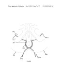 BODILY IMPLANTS AND METHODS OF TREATING FECAL INCONTINENCE USING BODILY     IMPLANTS diagram and image