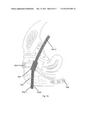 BODILY IMPLANTS AND METHODS OF TREATING FECAL INCONTINENCE USING BODILY     IMPLANTS diagram and image