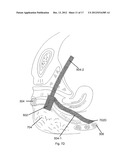 BODILY IMPLANTS AND METHODS OF TREATING FECAL INCONTINENCE USING BODILY     IMPLANTS diagram and image